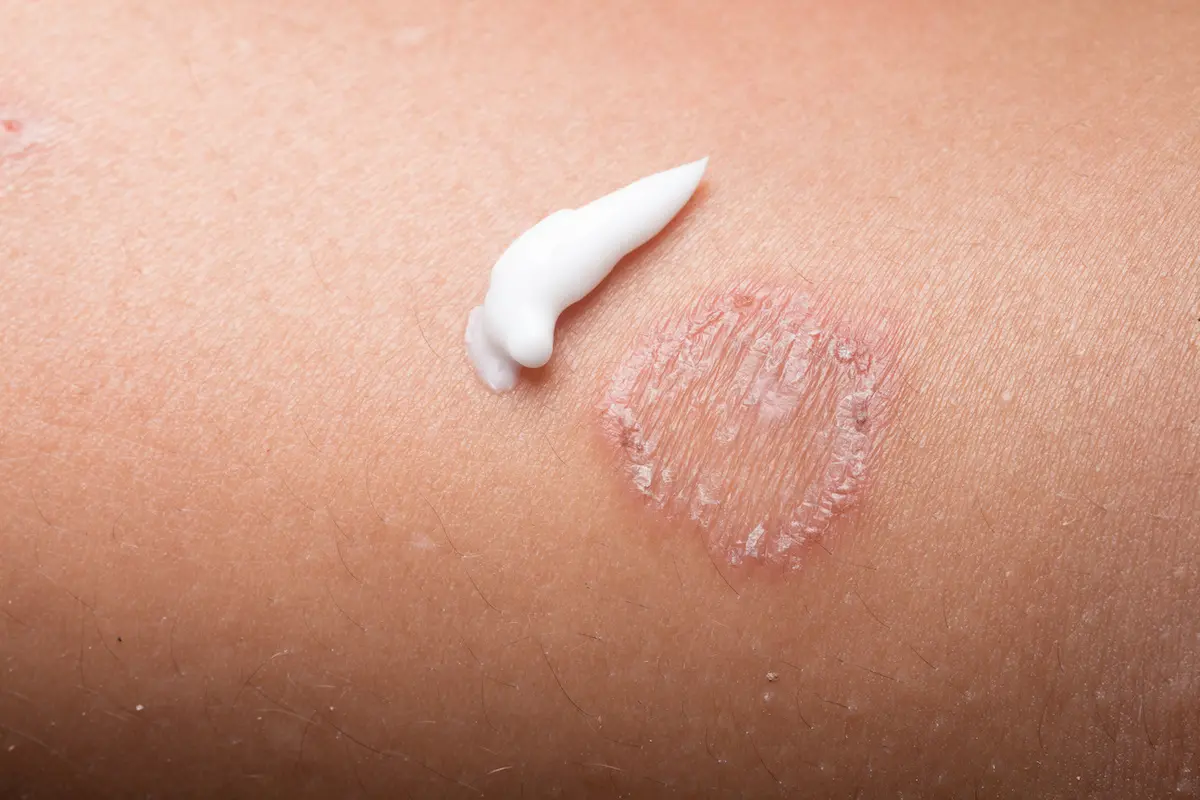 Fungal infection treatment in South Delhi : By Expert Dermatologist 2 fungal infection on skin