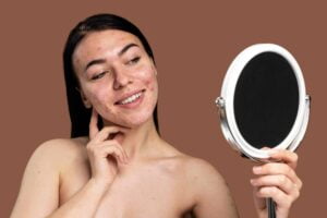 Read more about the article From Acne to Rosacea: Personalized Solutions by Dr. Neha Khuraana