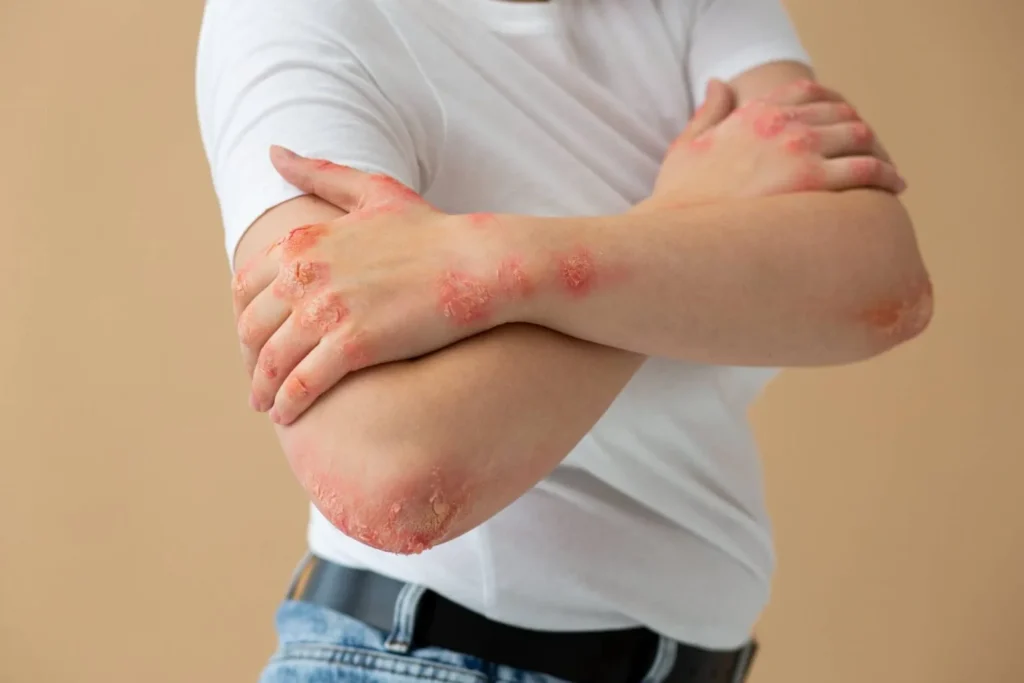 A men has psoriasis on his elbow and fingers