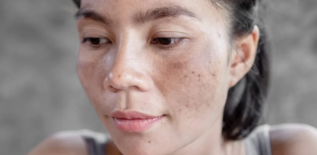 pigmentation on girl face