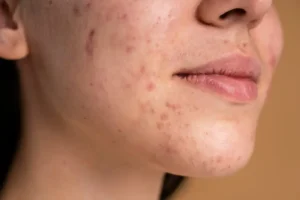 Read more about the article Acne Scars: Natural Treatment And Clinical Treatment