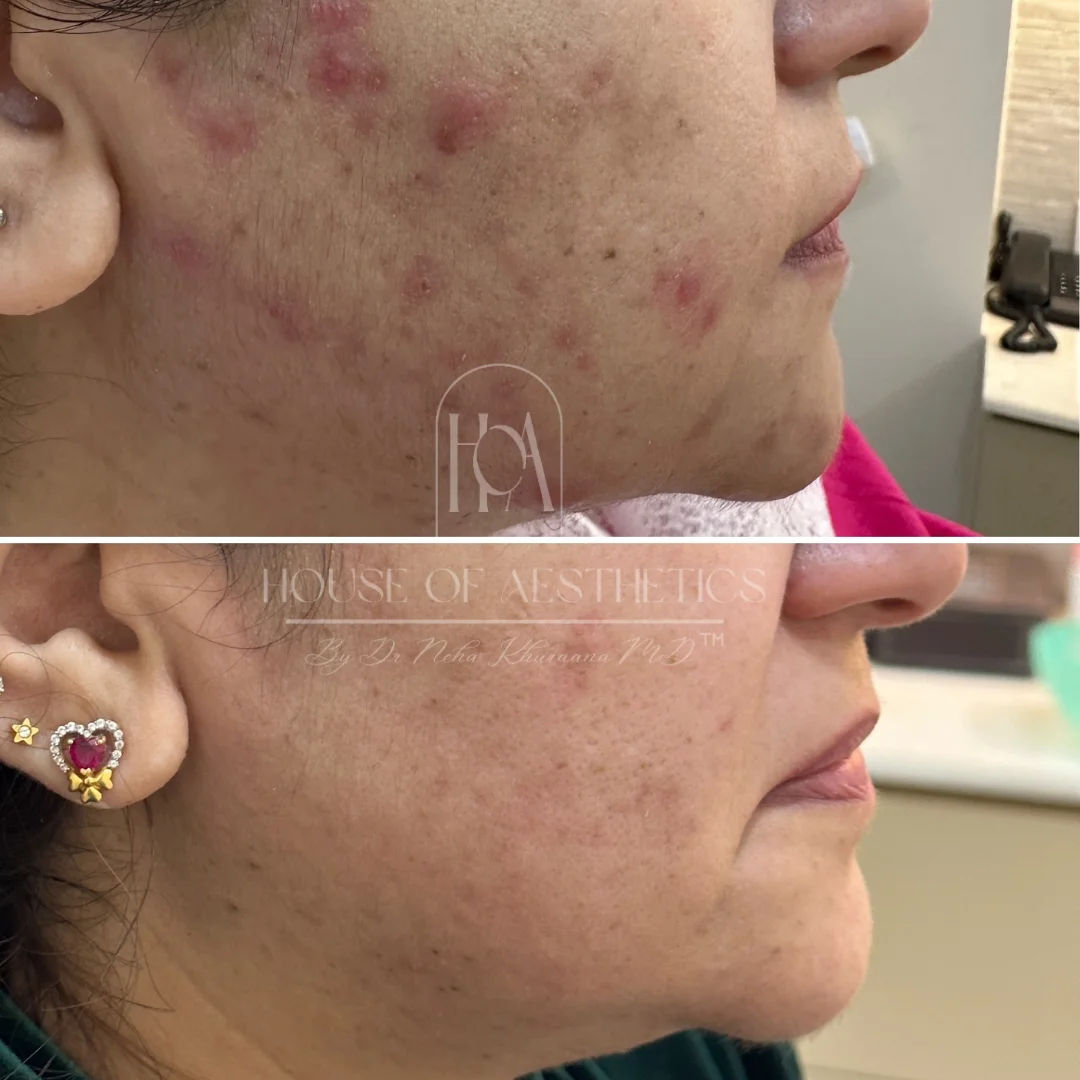 pigmentation treatment by south delhi's best dermatologist