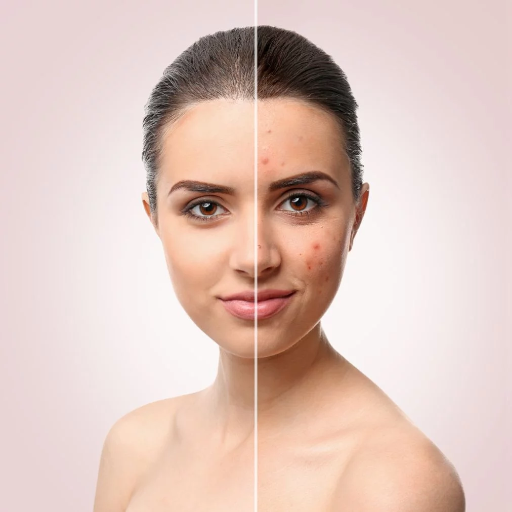 acne treatment in greater kailash