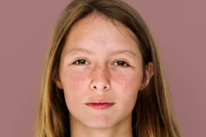 Read more about the article Your Ultimate Guide to Permanently Removing Pigmentation From Face