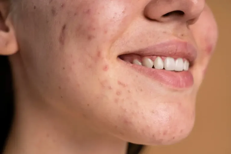 Read more about the article 5 Simple Tips For Acne Scars Treatment At Home