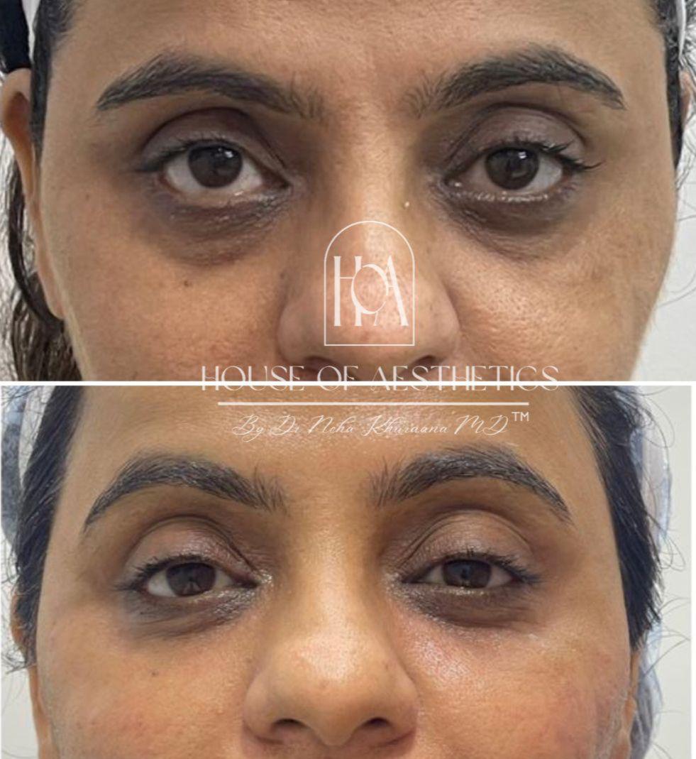 Filler Treatment in Greater Kailash 6 best eye filler in gk