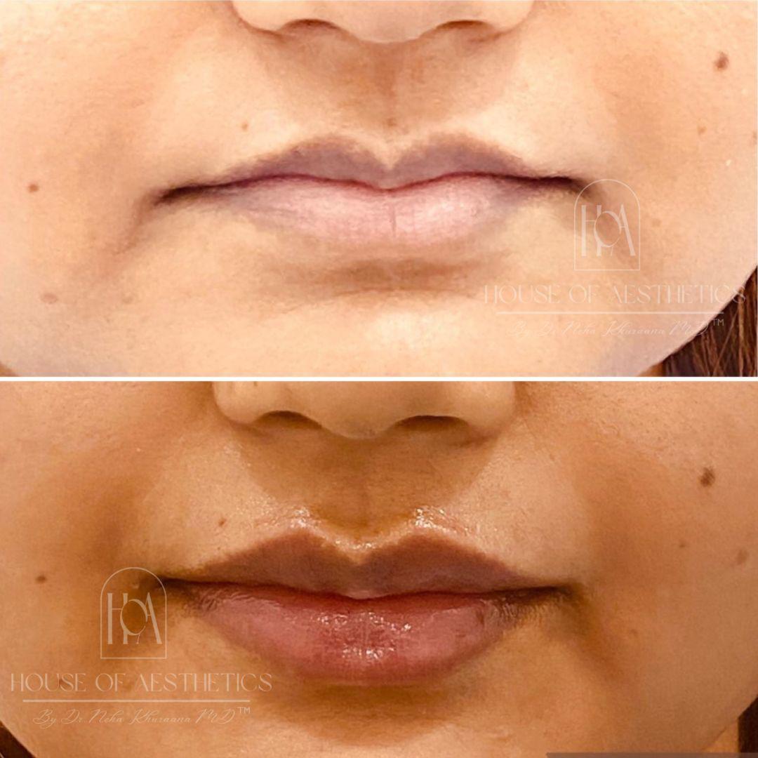 Filler Treatment in Greater Kailash 7 best lip filler in delhi
