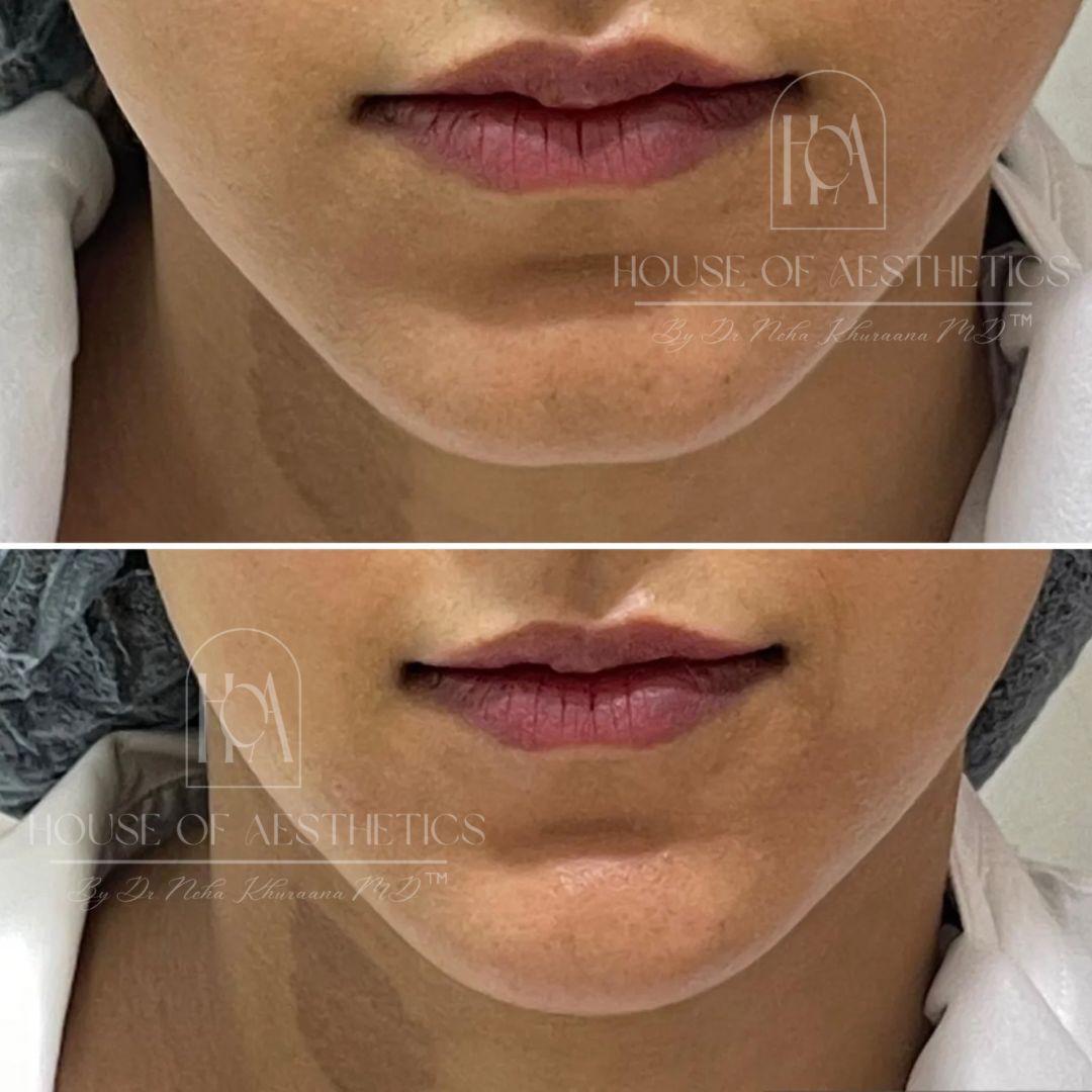 Filler Treatment in Greater Kailash 5 lip filler in greater kailash
