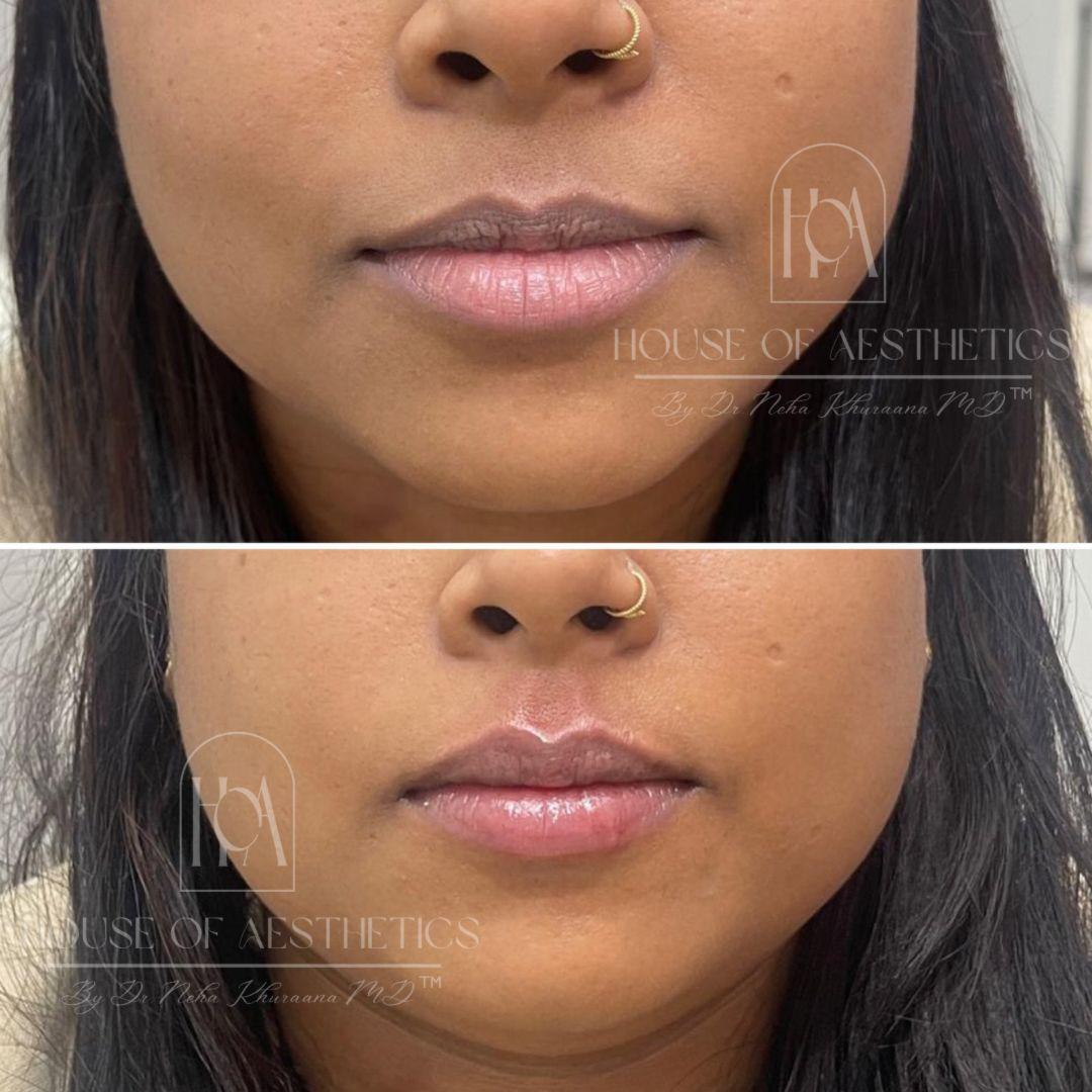 Filler Treatment in Greater Kailash 8 lip filler service in gk