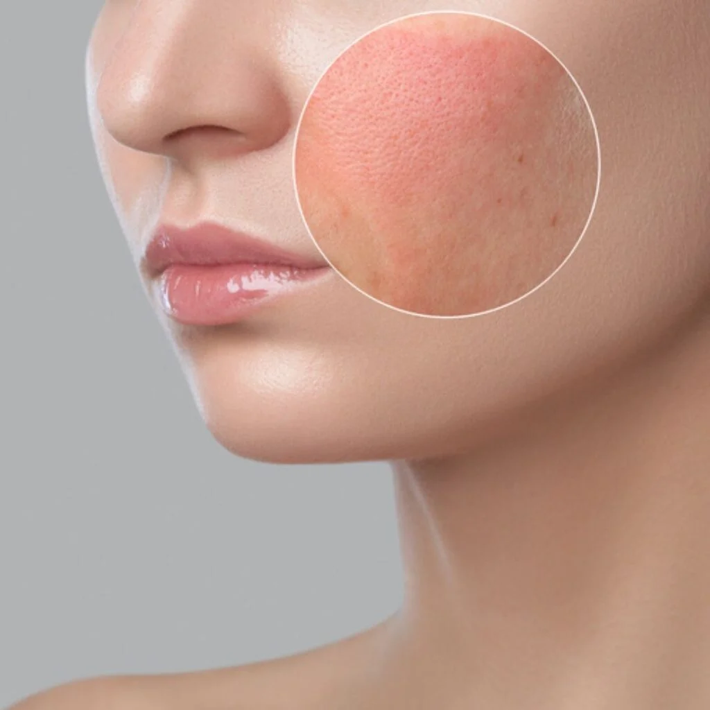 Pigmentation Treatment in Greater Kailash