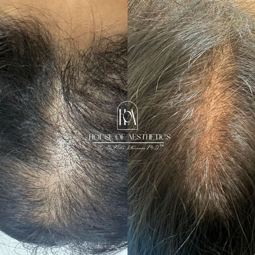 Hair Loss Treatment in Greater Kailash 7 Best Dermatologist in Delhi (2)