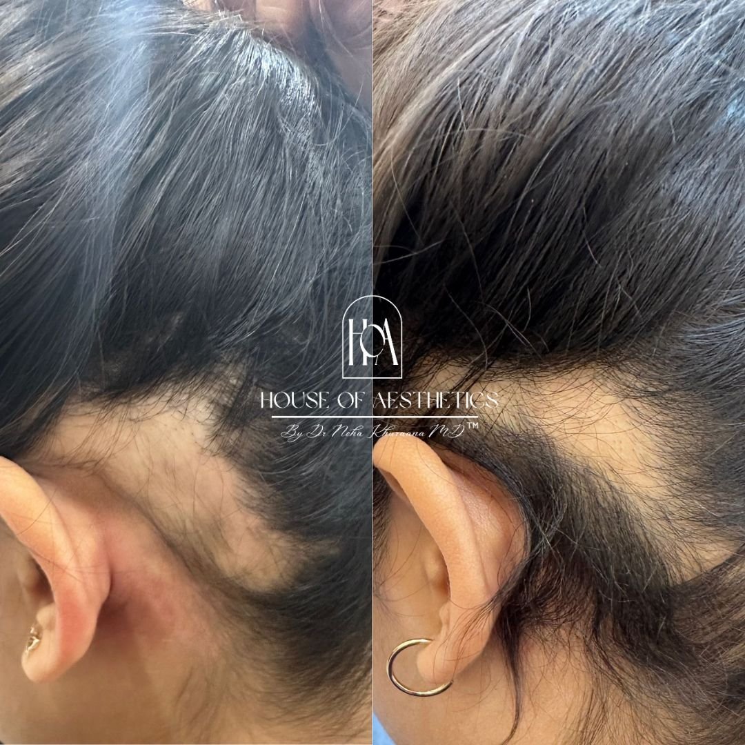 Hair Loss Treatment in Greater Kailash 6 Best Dermatologist in Delhi (3)