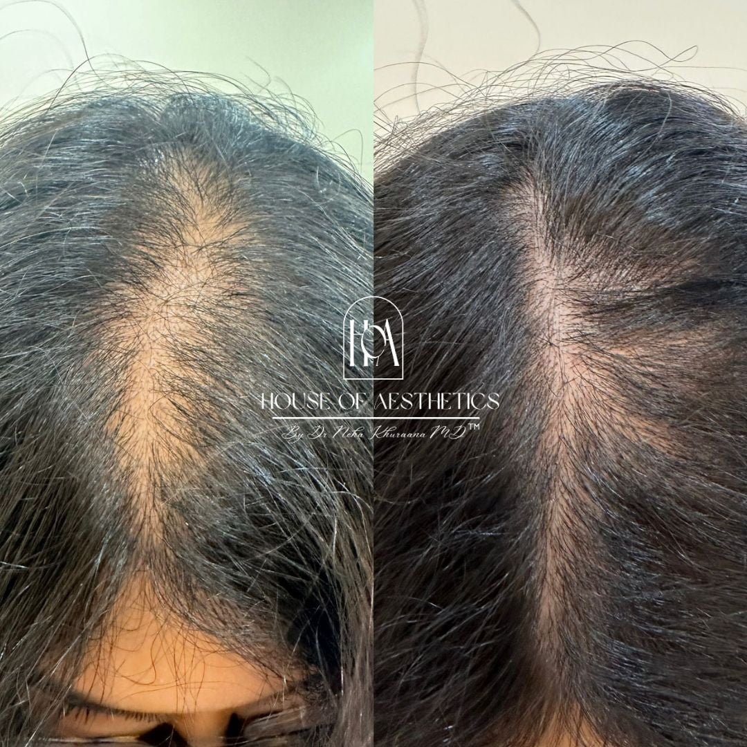 Hair Loss Treatment in Greater Kailash 5 Top 10 Skin and Hir Clinic