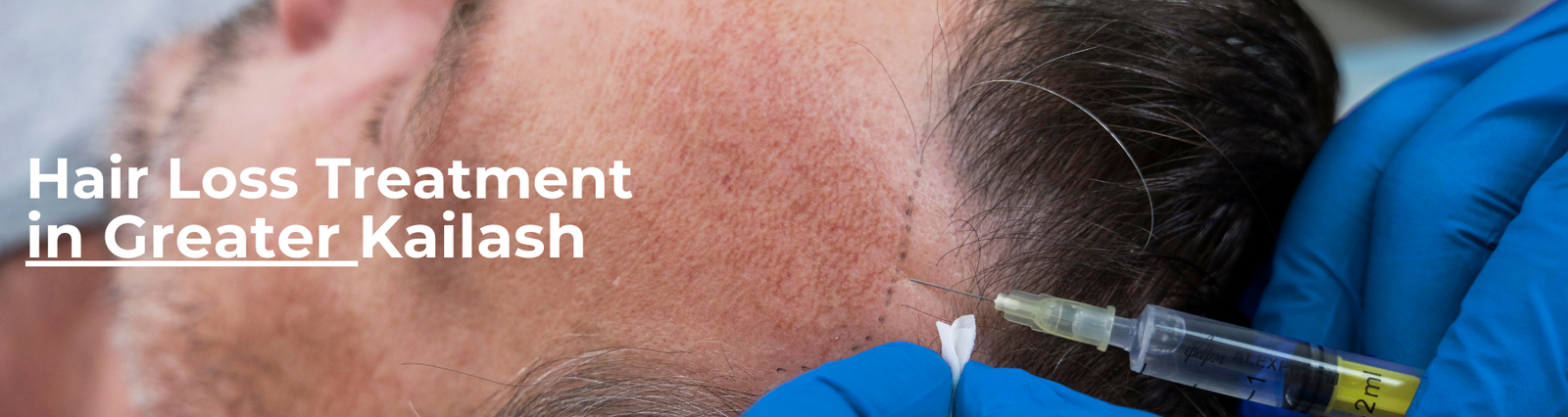Hair Loss Treatment in Greater Kailash 1 Hair loss treatment
