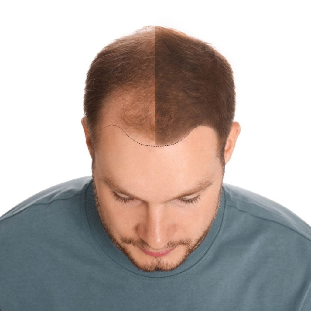Hair Loss Treatment in Greater Kailash 2 hair loss treatment in delhi