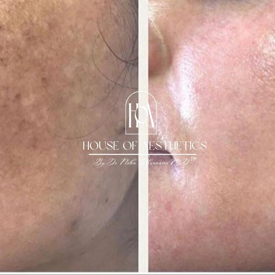 pigmentation treatment by south delhi's best dermatologist