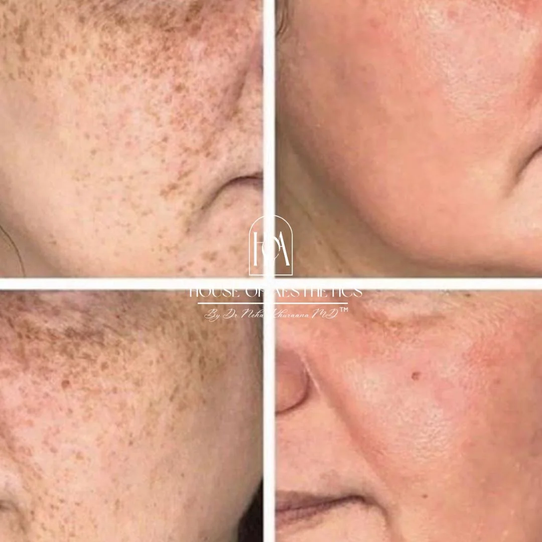 After before skin treatment by Dr neha khuraana