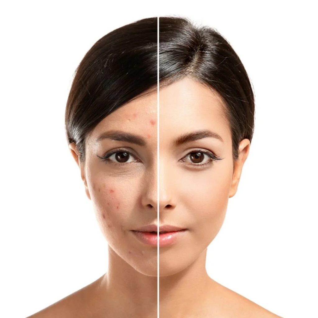 Best Acne Treatment in Greater Kailash