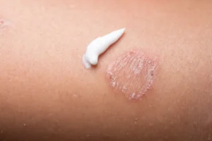 Read more about the article Fungal infection treatment in South Delhi : By Expert Dermatologist