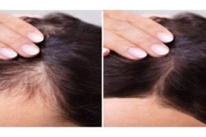 Read more about the article The Science Behind Laser Hair Reduction: Why It’s the Best Option at HOA