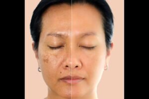 Read more about the article Understanding Hyperpigmentation Treatment In South Delhi: Dr. Neha Khuraana’s Guide to Even-Toned Skin