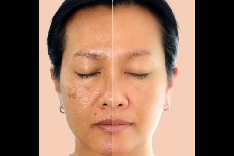 Read more about the article Understanding Hyperpigmentation: Dr. Neha Khuraana’s Guide to Even-Toned Skin