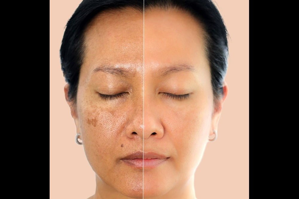 You are currently viewing Understanding Hyperpigmentation Treatment In South Delhi: Dr. Neha Khuraana’s Guide to Even-Toned Skin