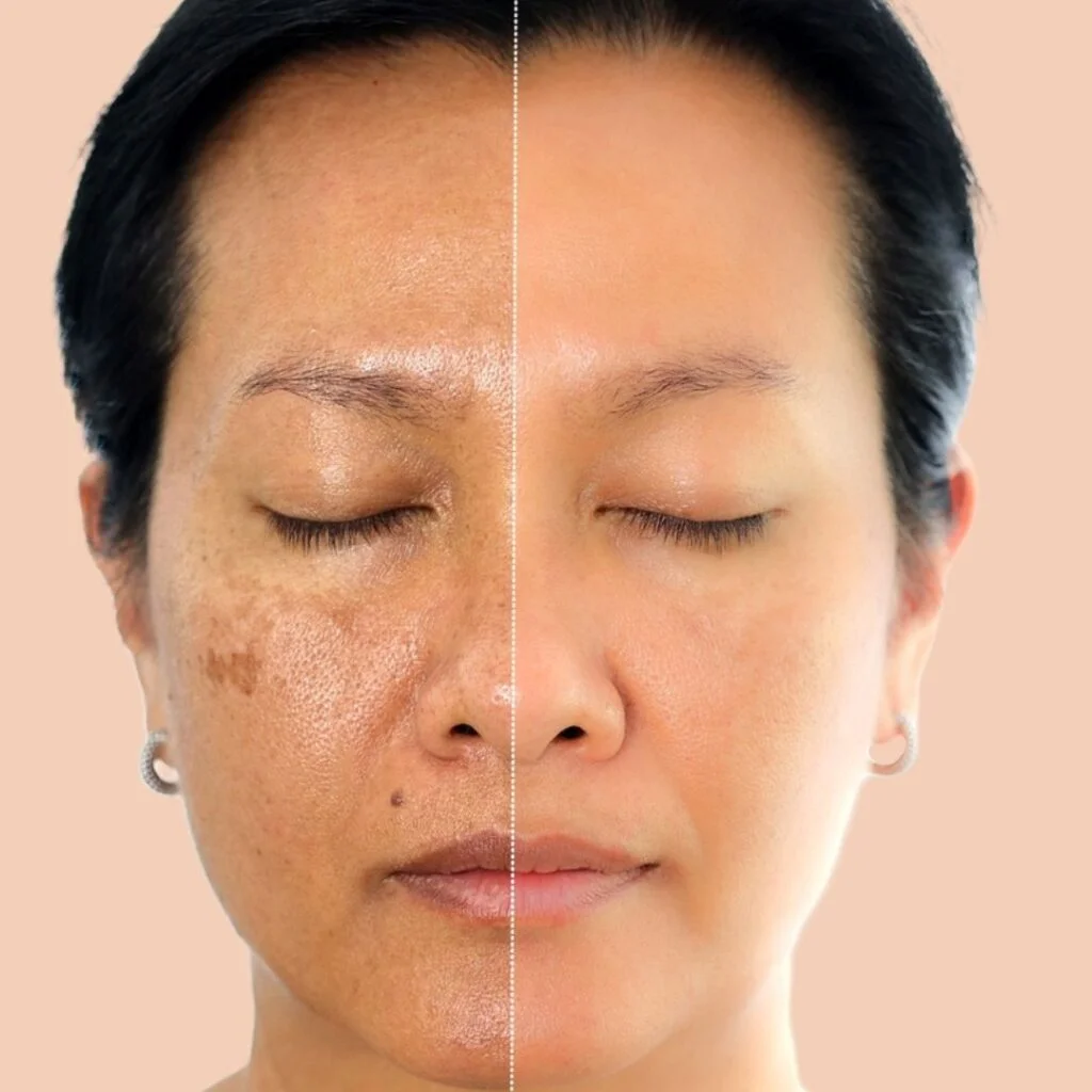 Pigmentation Treatment
