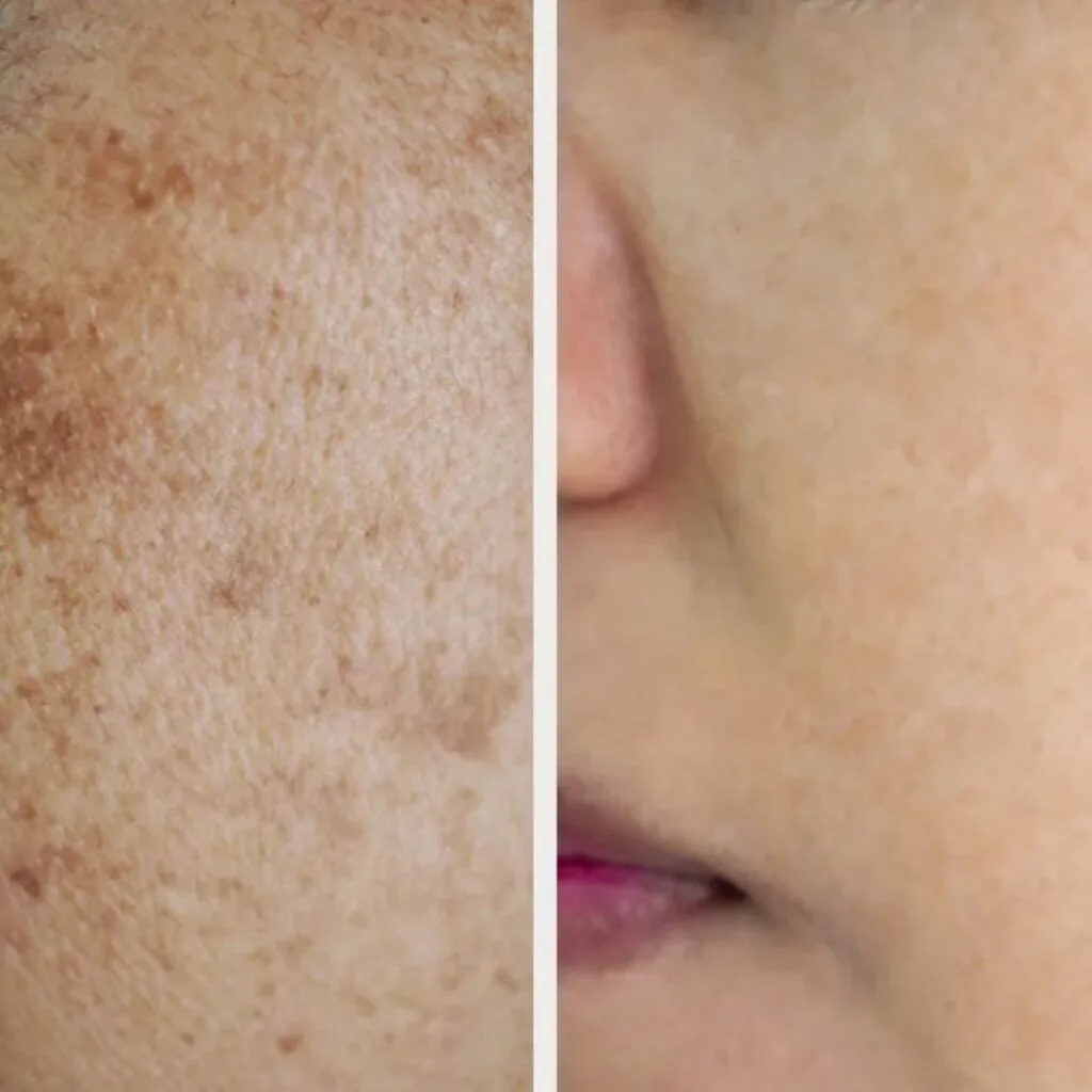 Q-Switch Laser Treatment in Greater Kailash