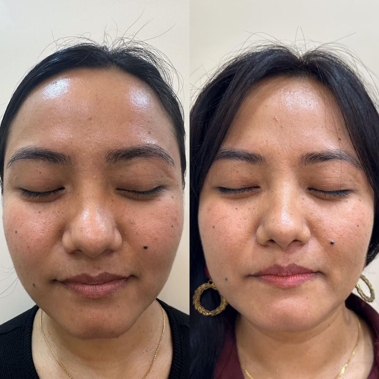 Best Hydra Facial in South Delhi 5 WhatsApp Image 2024-11-22 at 19.21.52