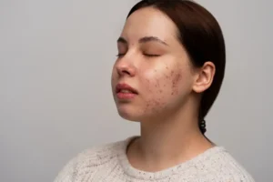 Read more about the article Foods that trigger acne: What to avoid for clear skin?