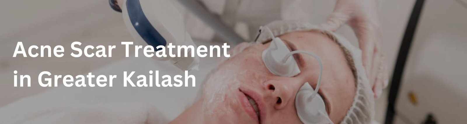 Acne scar treatment in greater kailash Acne Scar Treatment in Greater Kailash