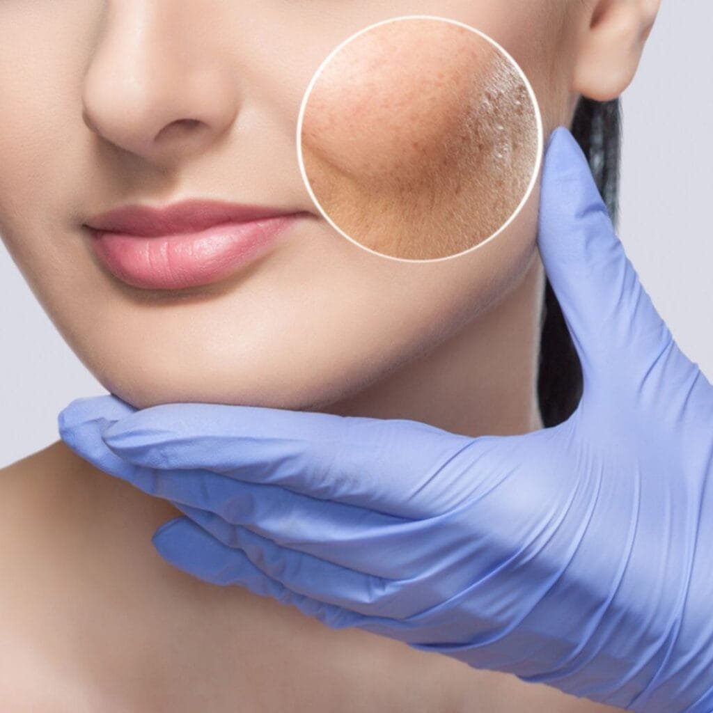 Acne scar treatment in greater kailash