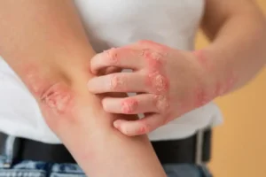 Read more about the article Seasonal Eczema: How to Avoid them with Right Eczema Treatment