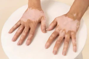 Read more about the article Vitiligo: Causes, symptoms and treatment options
