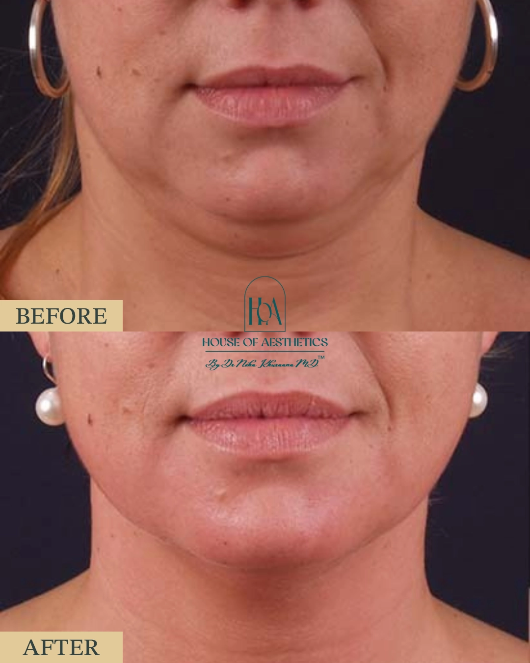 EXILIS at HOA Body Lab 3 1