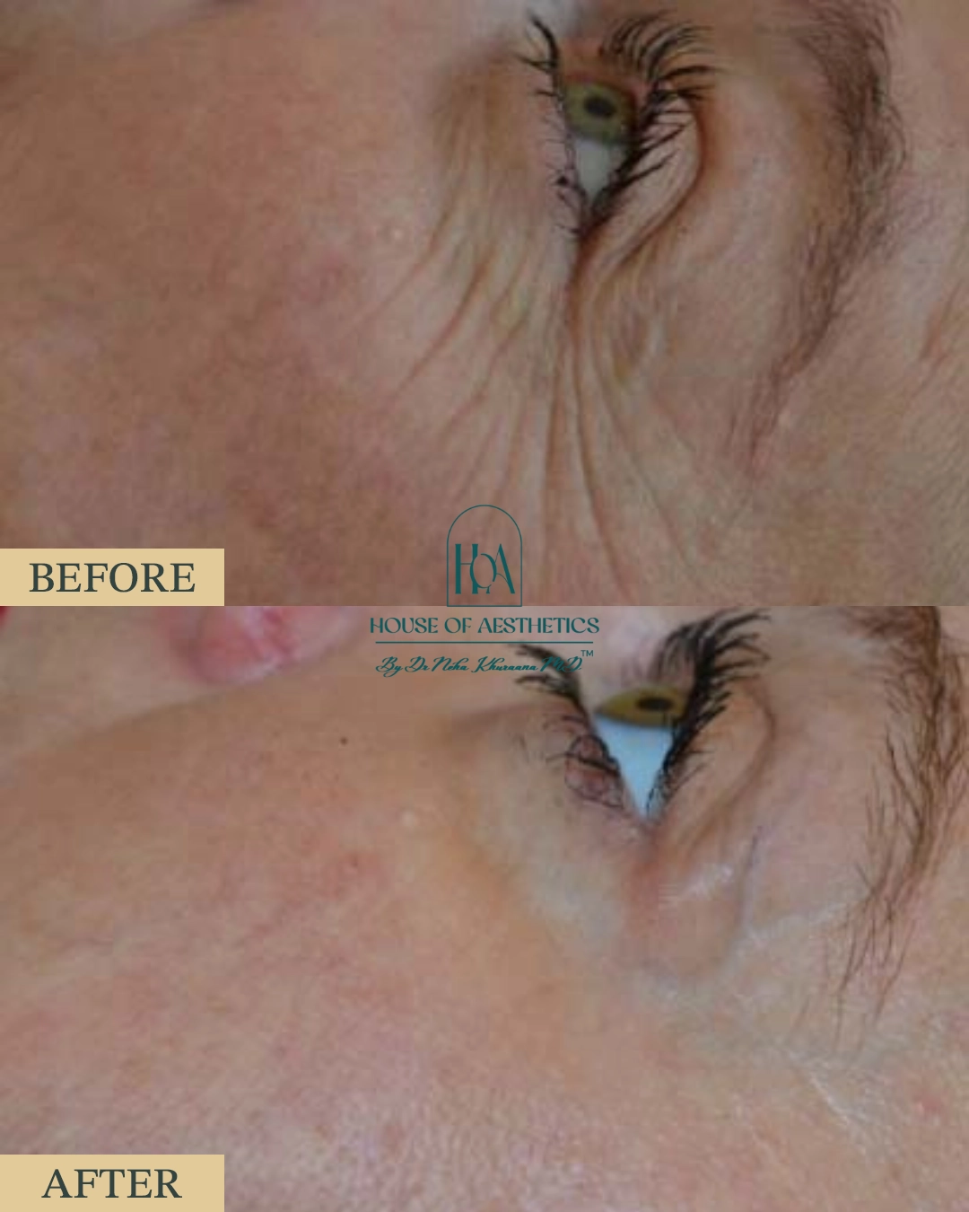 EXILIS at HOA Body Lab 4 2