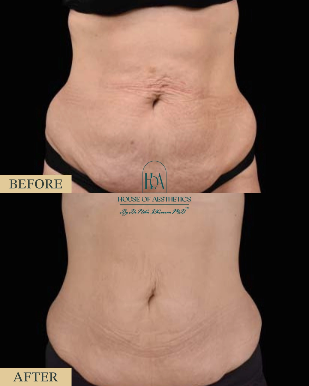 EXILIS at HOA Body Lab 5 3