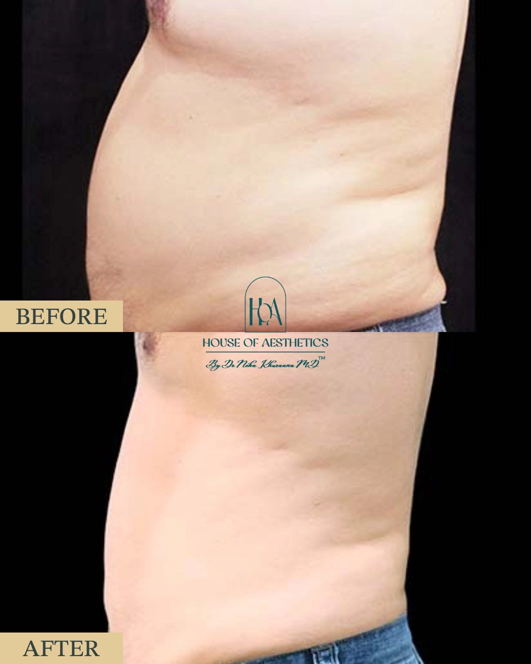 EXILIS at HOA Body Lab 6 4