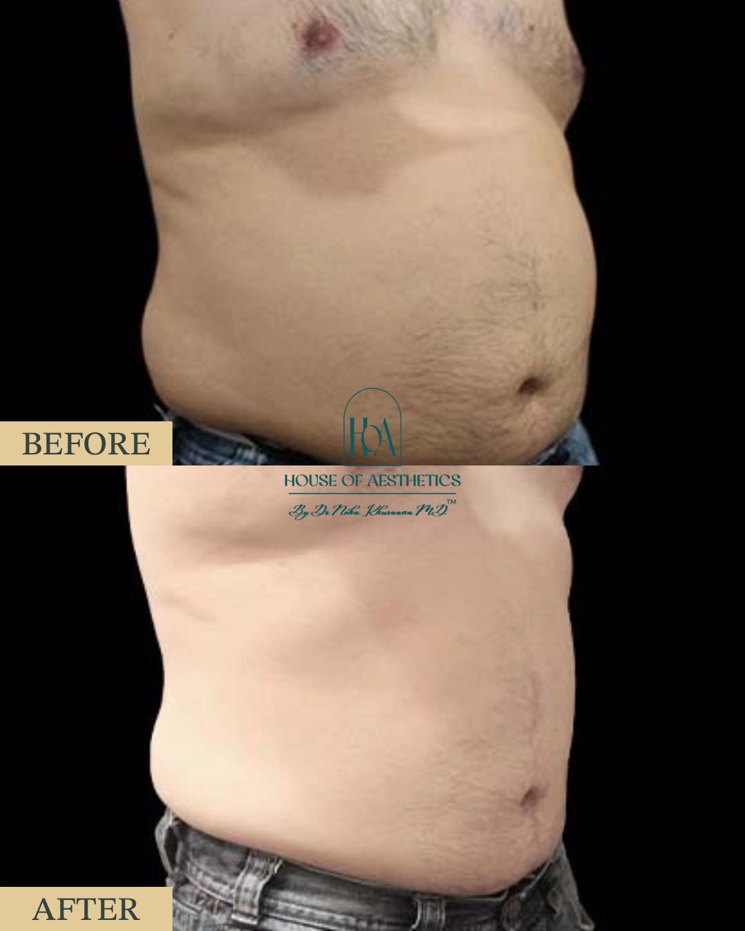 EXILIS at HOA Body Lab 7 5
