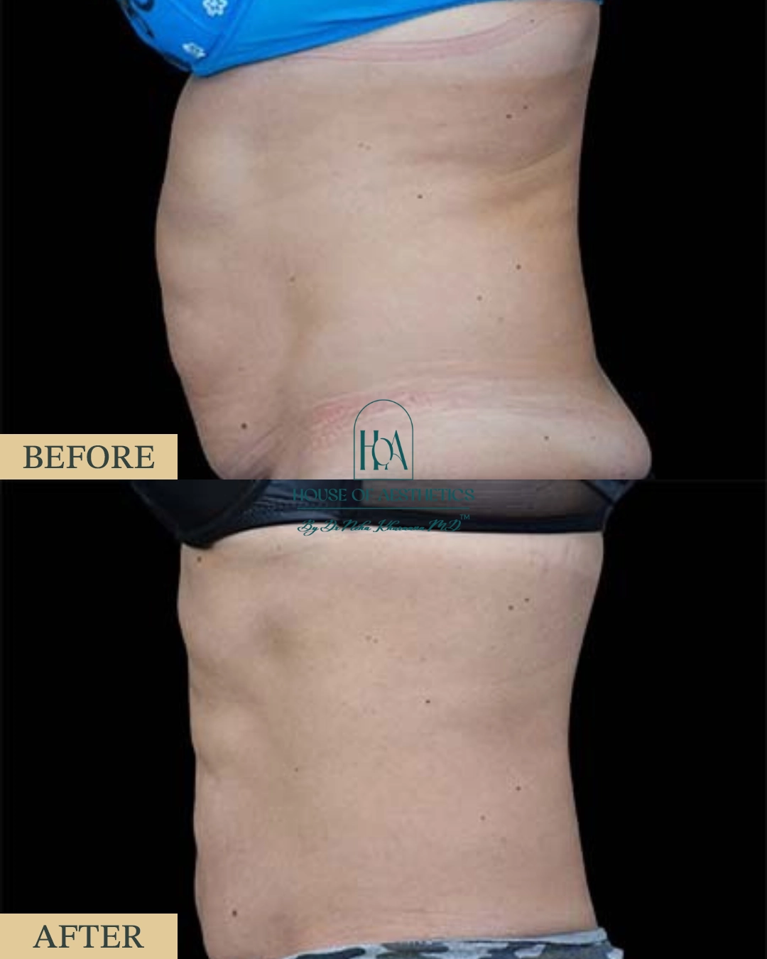 EXILIS at HOA Body Lab 8 6