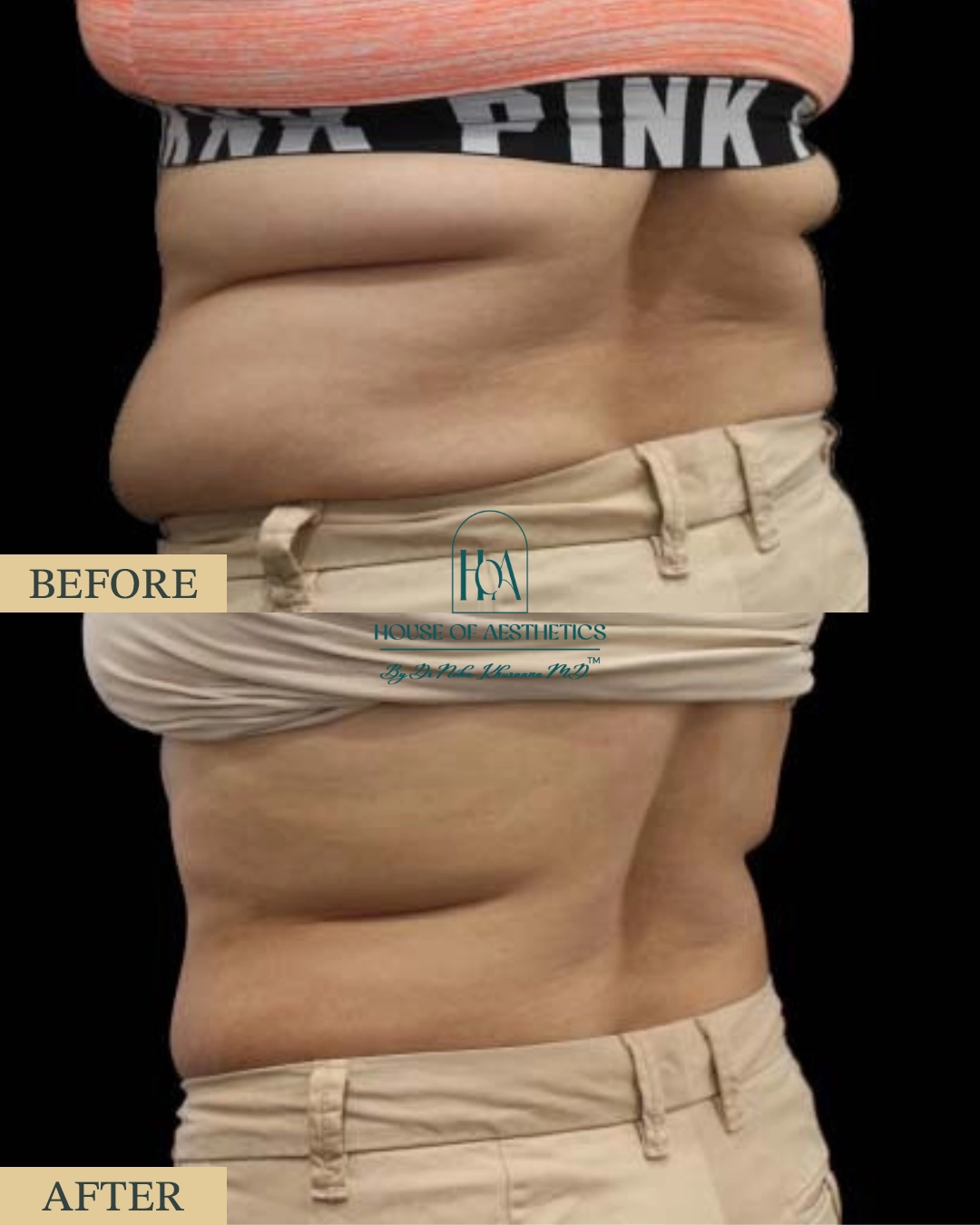 EXILIS at HOA Body Lab 9 7