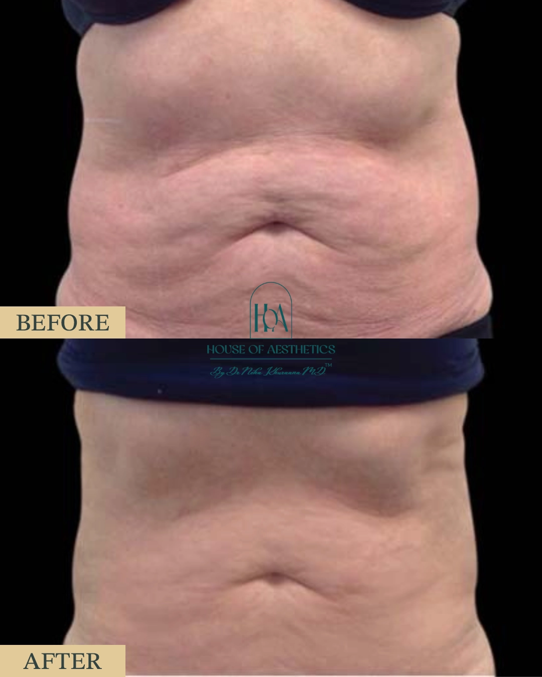 EXILIS at HOA Body Lab 10 8