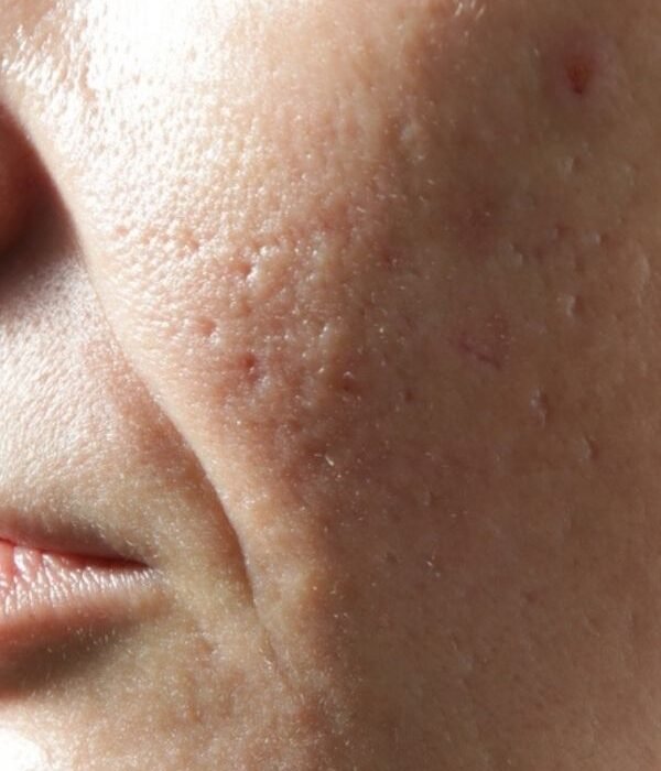 Open Pores Treatment in Greater Kailash