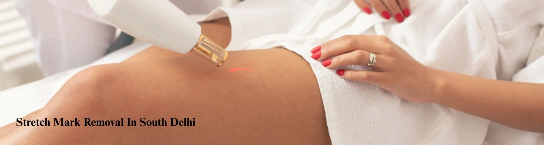 Stretch Mark Removal in South Delhi