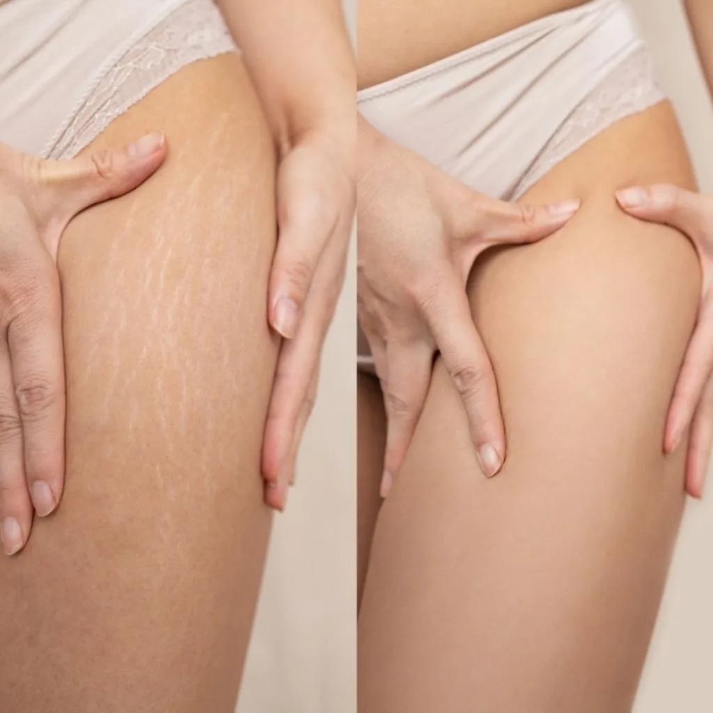 Stretch Mark Removal in South Delhi