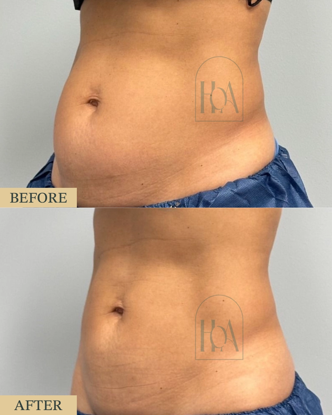 Cryosculpt-R™ Cryolipolysis at HOA Body Lab cryolipolysis1