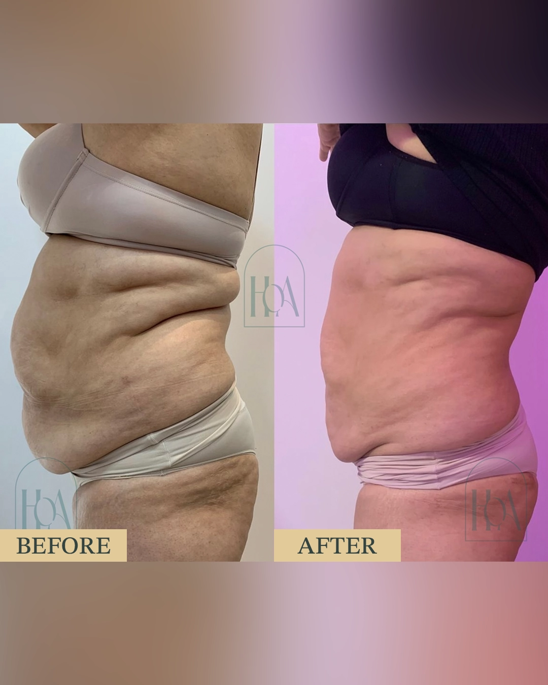 Lipolysis Injections at HOA Body Lab lipolysis1