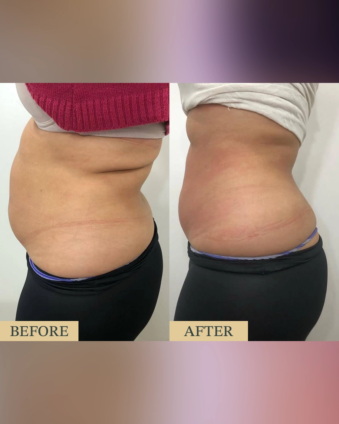 Lipolysis Injections at HOA Body Lab lipolysis2