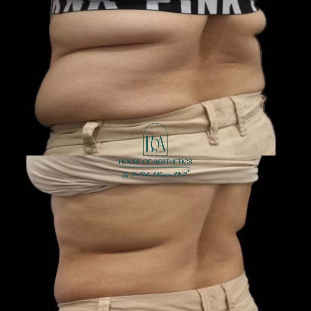 Hifu Treatment in Greater Kailash 10 slider1
